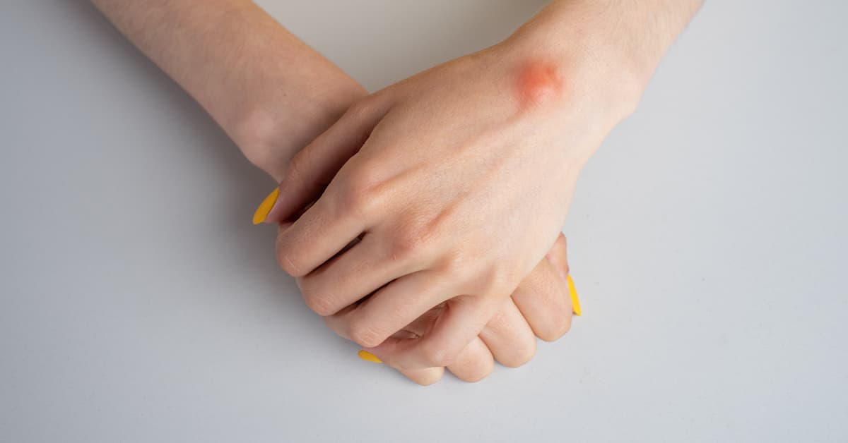 ganglion cyst treatment boise